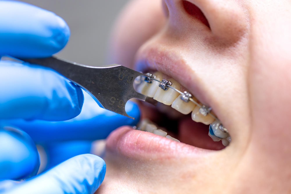 Orthodontic Treatments