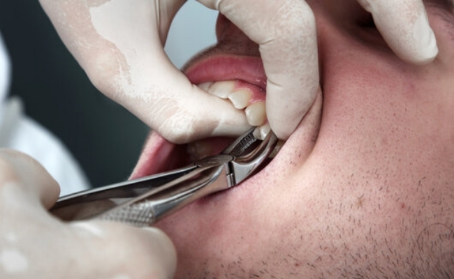 Tooth Extraction
