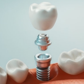 Dental Implants