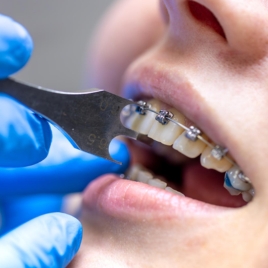 Orthodontic Treatments