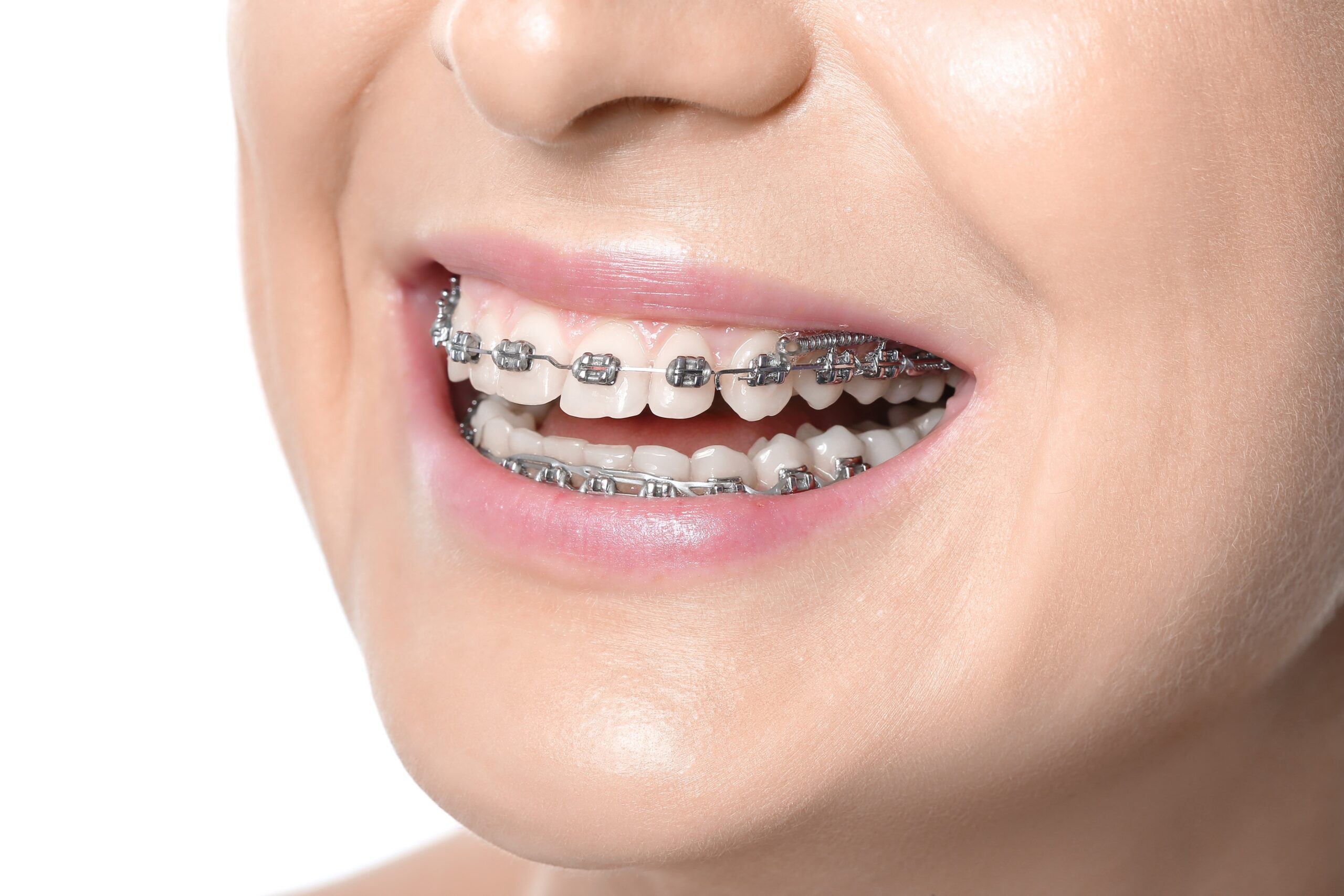 braces